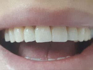 faccette dentali