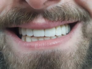 faccette dentali